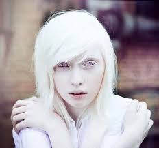 Imagine Albino White And Beauty Albino Girl Albino Model Albinism
