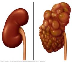 Polycystic Kidney Disease Symptoms And Causes Mayo Clinic