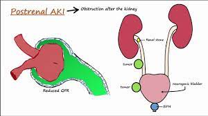 Might they be a contributing factor to the. Acute Kidney Injury Aki Prerenal Intrarenal Postrenal Youtube