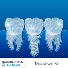 Hagakliniken slog upp sina dörrar i hjärtat av göteborg 2006 och har sedan dess vaccinerat och tagit. Implantatbehandlingar Innebar Att Vi Haga Kliniken Solna Ab Facebook