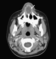 Foreign bodies frequently cause vestibulitis in children due to purulent discharge. Nasal Septal Abscess In An Immunocompetent Child Sciencedirect