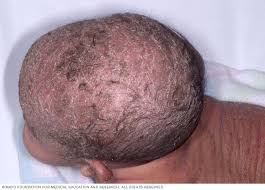 Image result for white scabs on the head in children
