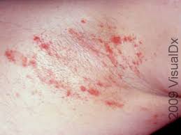 Image result for sore skin in the groin area