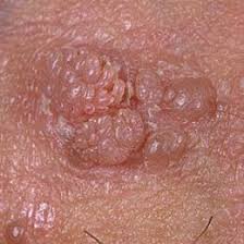 Image result for genital warts