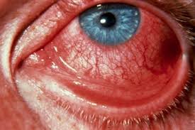 Image result for Gonococcal Conjunctivitis