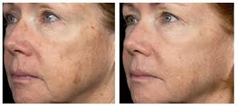 Fraxel Laser Resurfacing Of The Face About Face Skin Care Laser Resurfacing Face Skin Care Laser Rejuvenation