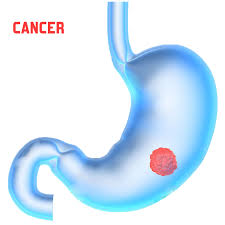 Stomach cancer stories | symptoms, diagnosis, treatment adenocarcinomas. Stomach Cancer Treatment Coimbatore Stomach Cancer Hospital In India
