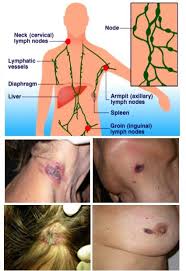 Bone marrow involvement in hodgkin's disease: 110 Hodgkins Lymphoma Ideas Hodgkins Lymphoma Lymphoma Cancer