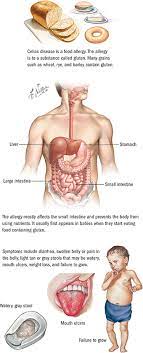 Celiac disease is a chronic digestive and immune disorder that damages the small intestine. Celiac Sprue Gastroenterology Spectrum Health