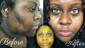 5 Day Turmeric Face Mask Cleared My Hyperpigmentation Im Shook Youtube