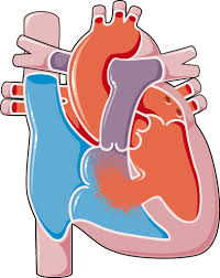 Image result for Ventricular Septal Defect