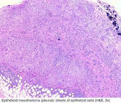 The prognosis of desmoplastic malignant mesothelioma and its distinction from fibrous pleurisy. Pathology Outlines Mesothelioma Peritoneum Epithelioid