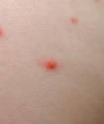 Let's start with cherry angiomas. Cherry Angiomas And Stress Lovetoknow