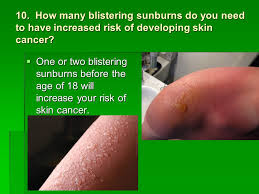 Otherwise known as sun sick or sun poisoning, sunburn poisoning is when your sunburn is so how to get rid of a sunburn. Skin Cancer Ppt Video Online Download