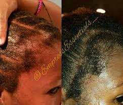 An increasingly common hair loss pattern in older women is a receding hairline (frontal fibrosing alopecia). Hair Loss Treatment Hair Growth Cream 2 Month Supply Balding Etsy In 2021 Black Women Hair Loss Hair Growth Cream Hair Loss