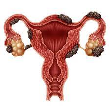 Maybe you would like to learn more about one of these? Endometriose Qizee