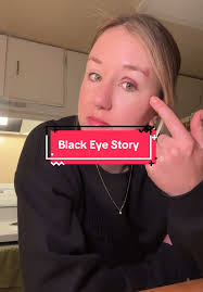 Gave myself a black eye 🤦🏻‍♀️