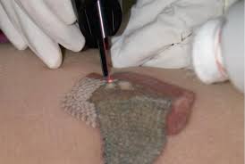 Actually, tattoo removal cost depends on the number of total sessions to remove the tattoo. Essential Laser Tattoo Removal Costs Are They Scary Tattoo Nexus