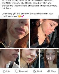 After 1 BBL/moxi laser with me 🫶🏻 #bbl #sciton #laser #moxi #pickleball