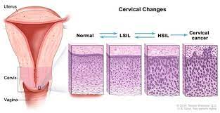Definition Of Low Grade Squamous Intraepithelial Lesion Nci Dictionary Of Cancer Terms National Cancer Institute