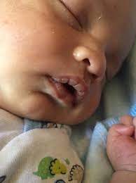 What to put on baby's chapped lips. Baby Chapped Lips Babycenter