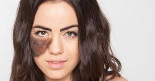 سنتكلم اليوم عن ماهو علاج كدمات العين او الضربات واكثرها لكمات في العين ههه بعنوان كيف اعالج كدمات العين الزرقاء وتأتي احيانا سوداء بطرق طبيعية يمكنك عملها في. Ù„Ùˆ Ù…Ø¶Ø§ÙŠÙ‚Ø§ÙƒÙ‰ 5 Ø·Ø±Ù‚ Ø·Ø¨ÙŠØ¹ÙŠØ© Ù„Ù„ØªØ®Ù„Øµ Ù…Ù† ÙˆØ­Ù…Ø© Ø§Ù„Ø¬Ù„Ø¯ Ø§Ù„ÙŠÙˆÙ… Ø§Ù„Ø³Ø§Ø¨Ø¹