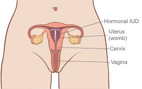 That's a pretty wide range, but the good news is that iuds can be free or low cost with many health insurance plans, medicaid, and some other government programs. Mirena Iud Hormonal Iud Mirena Iud Mirena Insertion Iud Mirena Cost Mirena Iud Melbourne Family Planning Victoria