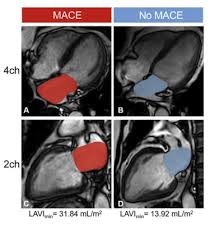 Image result for Cardiac MRI