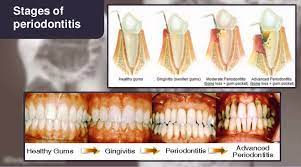 How to naturally cure tooth decay and gum disease? How To Regrow Bone Loss From Periodontal Disease Naturally