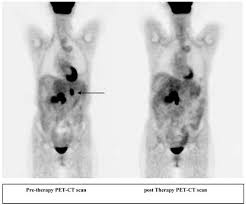 We did not find results for: Long Term Survival Toxicity Profile And Role Of F 18 Fdg Pet Ct Scan In Patients With Progressive Neuroendocrine Tumors Following Peptide Receptor Radionuclide Therapy With High Activity In 111 Pentetreotide