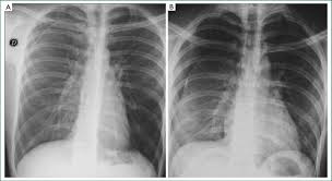 Distracting injuries such as fractures or peritonitis were also noted. Inspiration And Expiration Cxr In A Case Of Right Sided Spontaneous Download Scientific Diagram