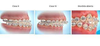 Maybe you would like to learn more about one of these? Por Que Me Han Puesto Gomas En Los Brackets Ferrus Bratos