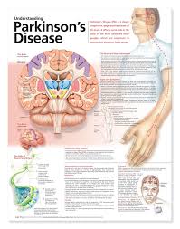 Understanding Parkinson S Disease Poster Parkinsons Anatomical Chart Company Parkinsons Disease Parkinsons Disease