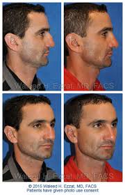 Maybe you would like to learn more about one of these? Nose Job For Men Boston Medical Center