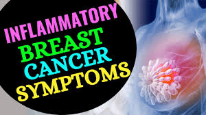 These develop within the connective. Sign And Symptoms Of Inflammatory Breast Cancer 2020 Inflammatory Breast Cancer Symptoms 2020 Youtube