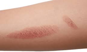 They can leave your skin feeling hot, sore, and tender to the touch. Are Laser Hair Removal Burns Common Skin Perfection Skin Perfection