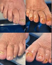 Image result for mykoza nehtů