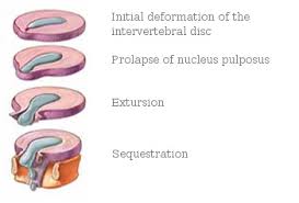 Image result for vyhřezlá ploténka