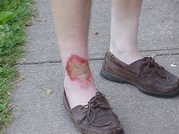 While these wounds may look and feel like burns, the term is a misnomer, since the treatment does not actually burn the skin. Burns Radiation