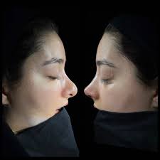 Rino endonasal, sin cicatriz, tenia 10 años de posoperada en otro cent...