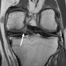 Maybe you would like to learn more about one of these? Posterior Horn Medial Meniscus Tear Knee Specialist Minnesota