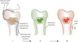 Image result for Osteomyelitis