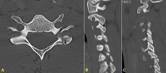Image result for Subaxial Injury Classification Scale