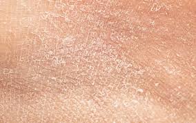 Image result for Dry Skin