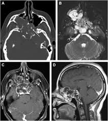 Image result for Chondrosarcoma