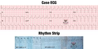Image result for Synchronized Cardioversion