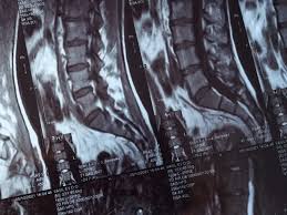 Image result for Syringomyelia