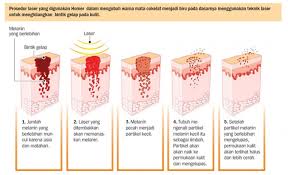 We did not find results for: Mengubah Mata Cokelat Menjadi Sebiru Langit Ilmu Dan Teknologi Koran Tempo Co
