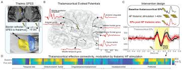 Image result for Thalamic Stimulation
