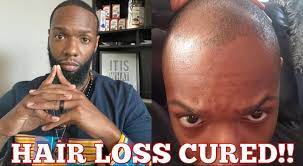 According to a book guide of urine therapy  rubbing urine on scalp can promote hair growth and prevent hair loss. How To Naturally Restore Your Hairline With Urine Therapy In 2021 Urine Therapy Hair Loss Cure Hair Loss